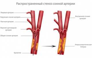 Каротидная эндартерэктомия: методика хирургической коррекции нарушений мозгового кровотока
