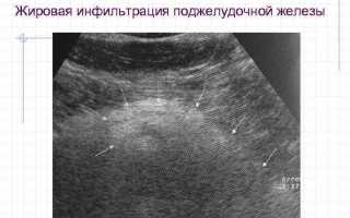 Что такое жировая инфильтрация поджелудочной и к чему она может привести?
