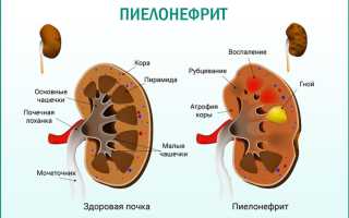 Почему болят почки и как справиться с проблемой в домашних условиях