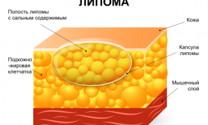 Липома молочной железы — что таит в себе патология