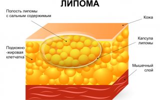Липома молочной железы — что таит в себе патология