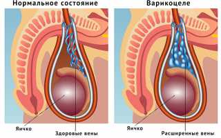 Варикоцеле: опасность заболевания и методы его лечение