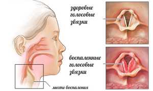 Лечение ларингита народными средствами – эффективно ли?