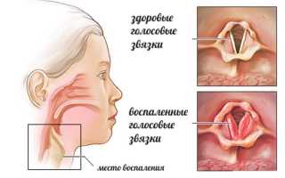 Лечение ларингита народными средствами – эффективно ли?