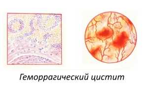 В чём опасность геморрагического цистита?