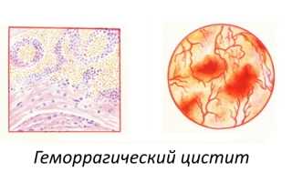 В чём опасность геморрагического цистита?