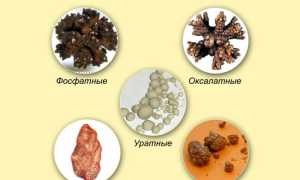Песок в почках у мужчин: чем грозит патология и как с ней справиться