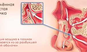 Насколько опасен катаральный гайморит?
