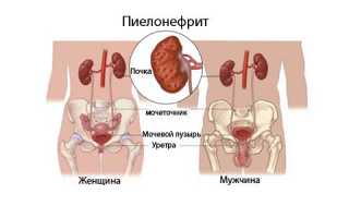 Анализ мочи при пиелонефрите: сбор материала и расшифровка результатов