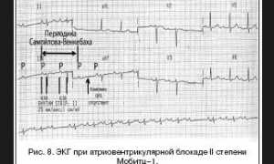 Диагностические критерии  нарушений работы проводящей системы сердца