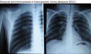 Курение при туберкулезе  и его влияние на  устойчивость к лекарственным препаратам