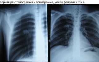 Курение при туберкулезе  и его влияние на  устойчивость к лекарственным препаратам