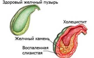 Хронический холецистит у взрослых и детей
