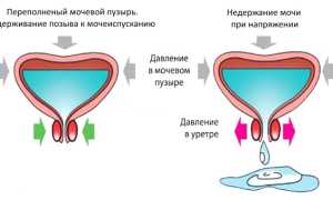 Недержание мочи у пожилых мужчин: как грамотно бороться с проблемой