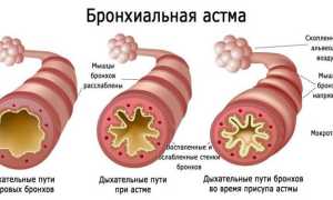 Бронхиальная астма