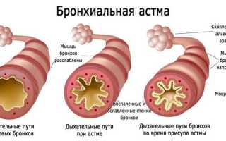 Бронхиальная астма