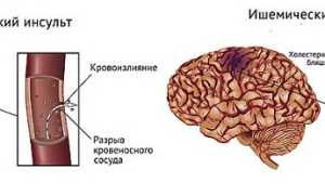 Геморрагический инсульт, его симптомы и методы лечения