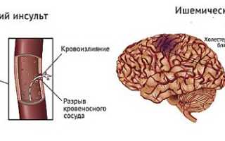 Геморрагический инсульт, его симптомы и методы лечения