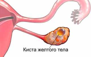Киста жёлтого тела: признаки, диагностика и методы лечения