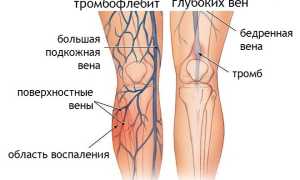 Основные проявления и современные методы лечения посттромбофлебитического синдрома