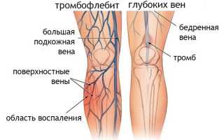 Основные проявления и современные методы лечения посттромбофлебитического синдрома