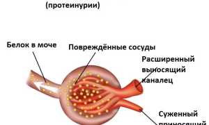 Альбуминурия: что это и как бороться с патологией