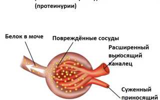 Альбуминурия: что это и как бороться с патологией