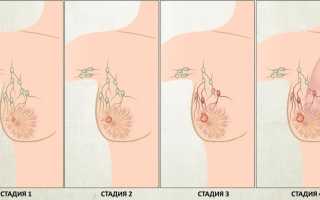Рак молочной железы 3 степени: признаки, формы и лечение