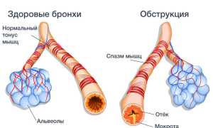 Обструктивный острый бронхит