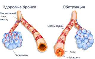 Обструктивный острый бронхит
