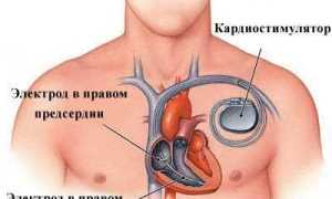 Как лечить хроническую сердечную недостаточность