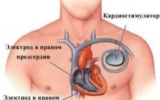 Как лечить хроническую сердечную недостаточность