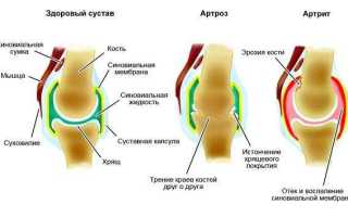 Чем отличается артрит от артроза