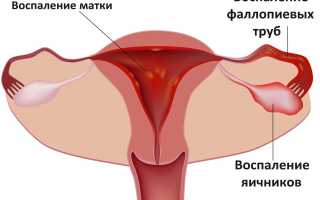 Острый и хронический аднексит