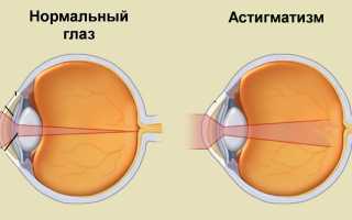 Астигматизм: коррекция зрения обязательна
