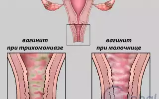 Как влияет на ребёнка кольпит у мамы при беременности