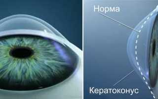 Кератоконус, его виды, симптомы, причины возникновения и лечение