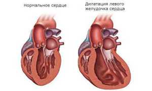 Дилатация камер сердца