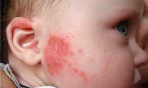 Аллергические   болезни   у детей и   вакцинация