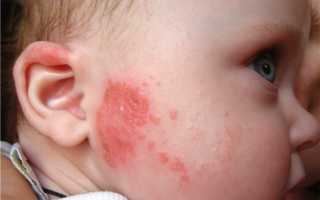 Аллергические   болезни   у детей и   вакцинация