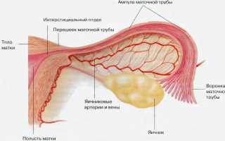 Сальпингит: признаки, диагностика, лечение