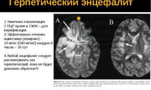 Случай  атипичного течения  герпетического  энцефалита  у  пациента  подросткового  возраста