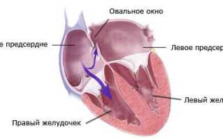 Открытое овальное окно: норма или сердечный порок?