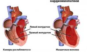 Кардиопатия – аномалия миокарда