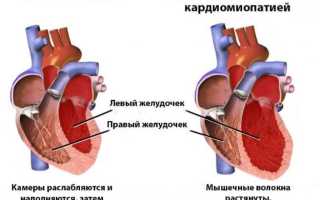Кардиопатия – аномалия миокарда