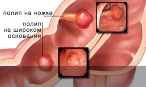 Эффективное лечение полипов в желудке народными средствами