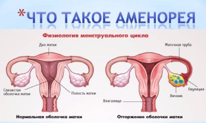Аменорея — методы борьбы с патологией