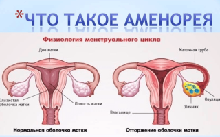 Аменорея — методы борьбы с патологией