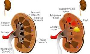 В чём заключается первичная и вторичная профилактика пиелонефрита