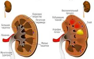 В чём заключается первичная и вторичная профилактика пиелонефрита